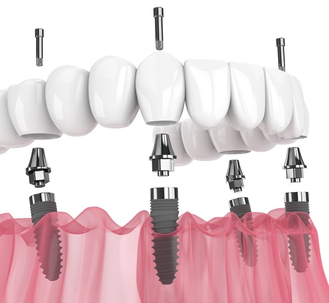all-on-4-dental-implants-in-newest-smile-dental