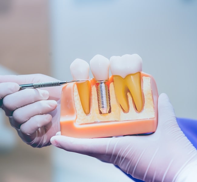 dental-implants-in-newest-smiledental